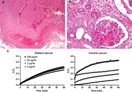 Antiphospholipid Antibody Syndrome