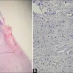 Antiphospholipid Syndrome