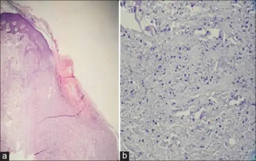 Antiphospholipid Syndrome