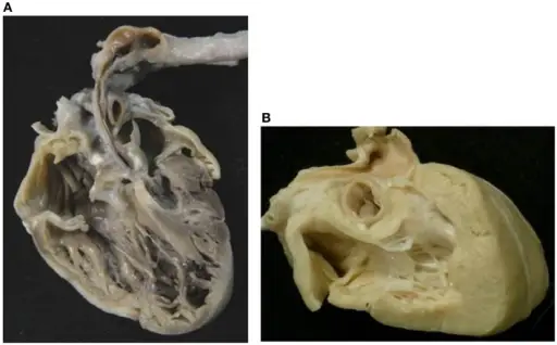 Aortic Atresia