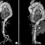 Aortic Dissection