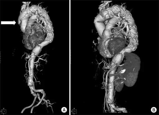 Aortic Dissection