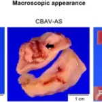 Aortic Stenosis