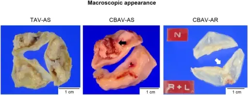 Aortic Stenosis