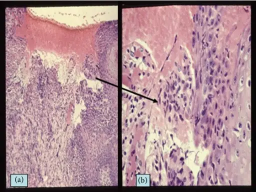 Aphthous Ulcers