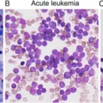 Aplastic Anemia