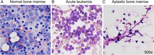 Aplastic Anemia