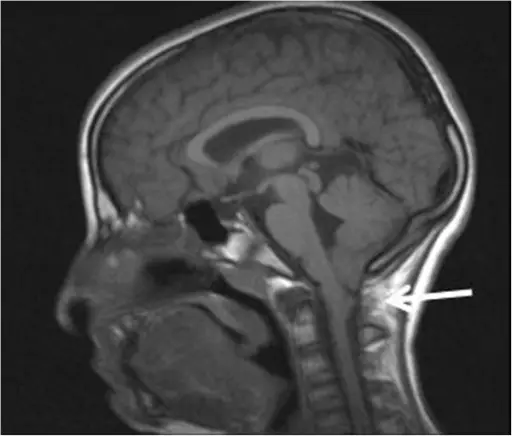 Arnold-Chiari Malformation