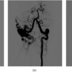 Arteriovenous Fistulas