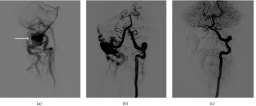 Arteriovenous Fistulas