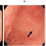 Aspirin Injury