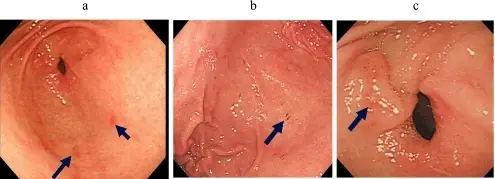 Aspirin Injury