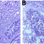 Ataxia-Telangiectasia