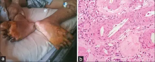 Atheroembolic Renal Disease