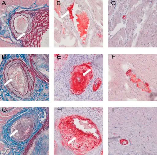 Atherosclerosis