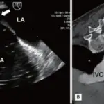 Atrial Septal Defect