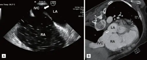 Atrial Septal Defect