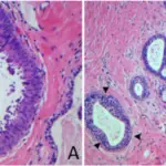 Atypical Ductal Hyperplasia