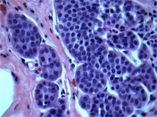 Atypical Lobular Hyperplasia