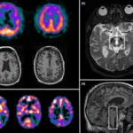 Atypical Parkinsonism Syndromes