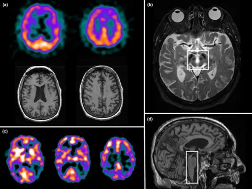 Atypical Parkinsonism Syndromes