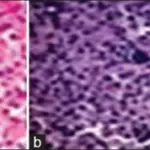 Atypical Rhabdoid Tumor