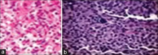 Atypical Rhabdoid Tumor