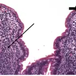 Autoimmune Enteropathy