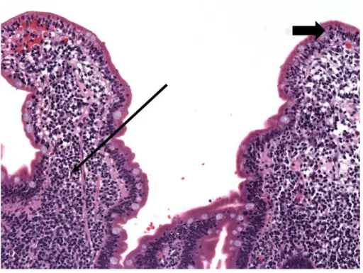 Autoimmune Enteropathy