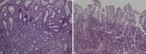 Autoimmune Gastritis