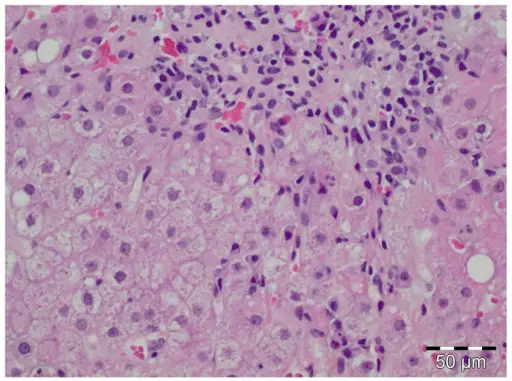 Autoimmune Hepatitis