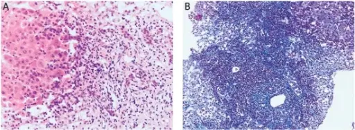 Autoimmune Polyendocrine Syndrome Type 1 (APS1)