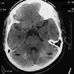 Autoimmune Polyendocrine Syndrome Type 2 (APS2)