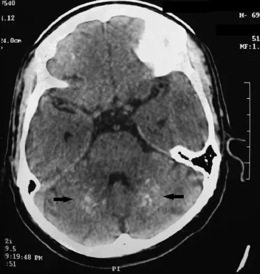 Autoimmune Polyendocrine Syndrome Type 2 (APS2)