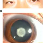 Autosomal Dominant Disorders