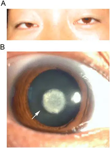 Autosomal Dominant Disorders