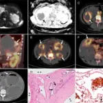 Autosomal Dominant Polycystic Kidney Disease