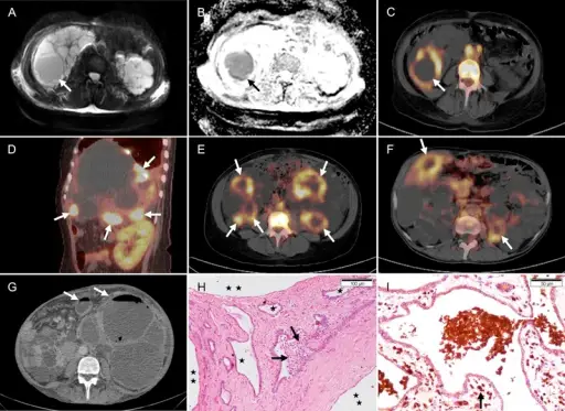 Autosomal Dominant Polycystic Kidney Disease