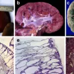 Autosomal Recessive Polycystic Kidney Disease