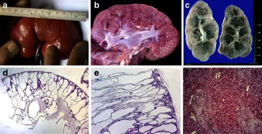 Autosomal Recessive Polycystic Kidney Disease