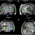 Axonal Reaction