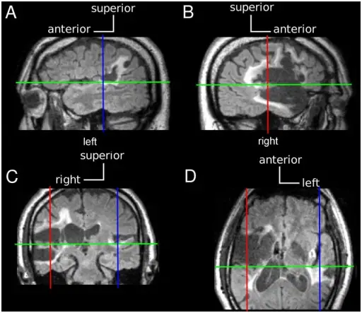 Axonal Reaction