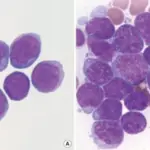 B-cell Acute Lymphoblastic Leukemia