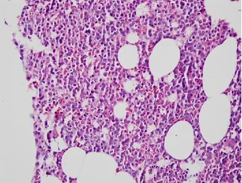 B-cell Prolymphocytic Leukemia