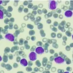 B-cell Prolymphocytic Leukemia