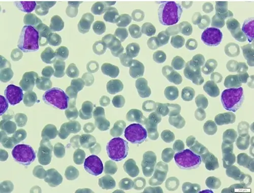 B-cell Prolymphocytic Leukemia