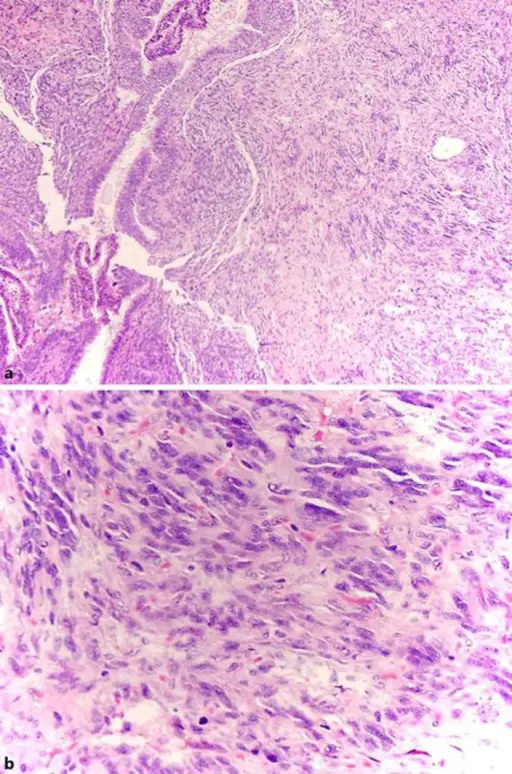 BREAST PATHOLOGY