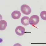 Babesiosis Infection