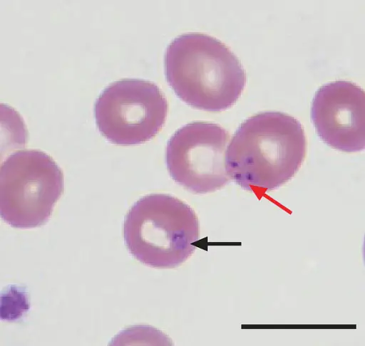 Babesiosis Infection