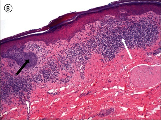 Basal Cell Carcinoma